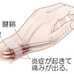 手首の痛み